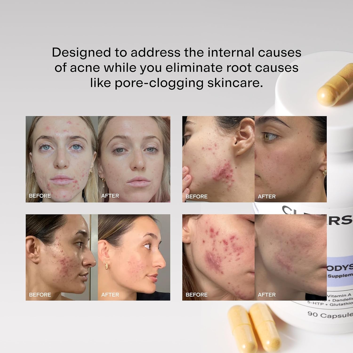 MINDBODYSKIN Hormonal Acne Supplement