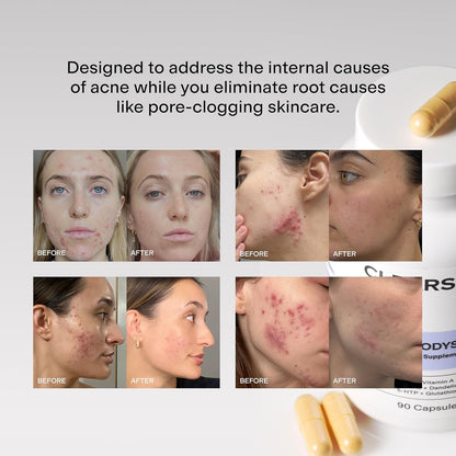 MINDBODYSKIN Hormonal Acne Supplement